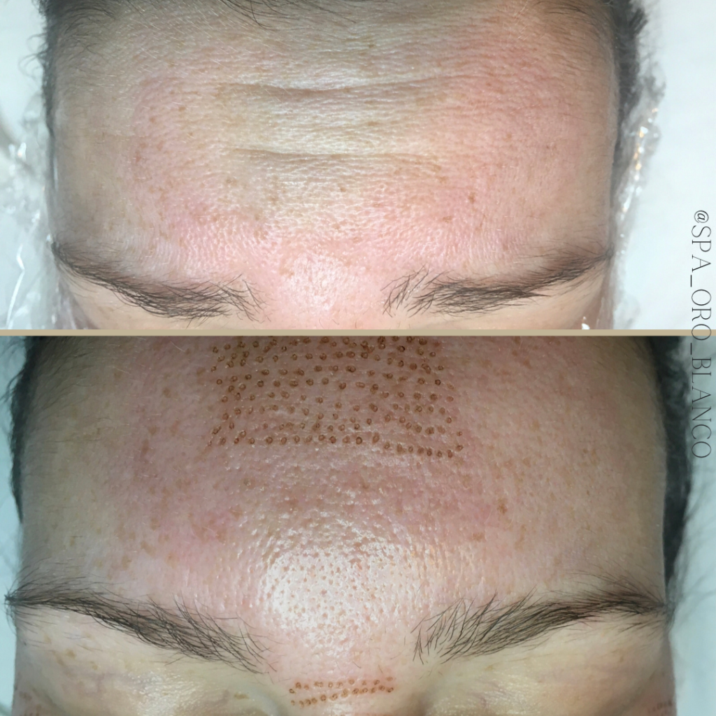 fibroblast skin treatment